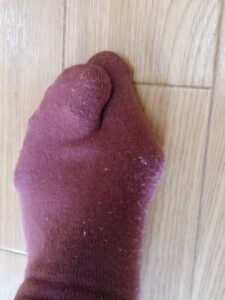 外反母趾（施術前）